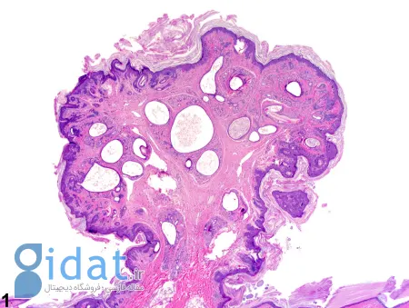 هامارتوما, تومور خوش خیم ریه