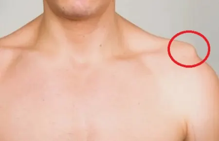 توده یا برآمدگی روی شانه: علل، علائم، تشخیص و درمان