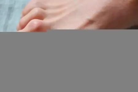 انگشت چکشی پا, پیشگیری از انگشت چکشی