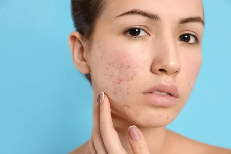 آیا محصولات ضد آکنه باعث خشکی پوست می‌شوند؟