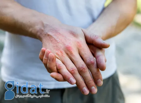 عوامل تشدید درماتیت آتوپیک, محرک‌های اگزما