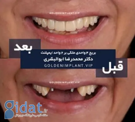 نمونه کار بهترین مرکز ایمپلنت در شمال تهران