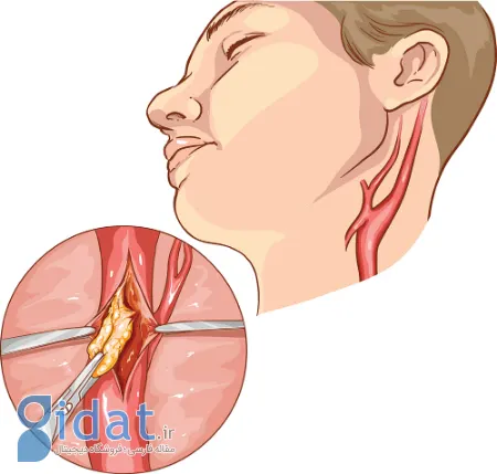 هر آنچه که باید در مورد جراحی اندارترکتومی کاروتید بدانید
