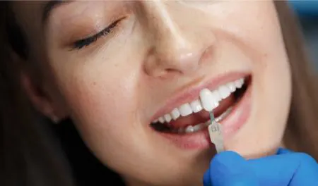 عوارض و مضرات کامپوزیت دندان