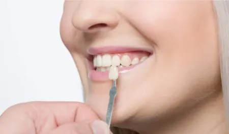 کامپوزیت دندان