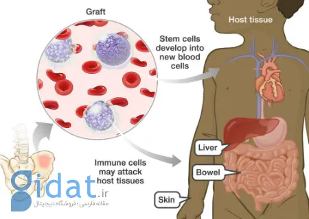 بیماری پیوند در مقابل میزبان, بیماری پیوند علیه میزبان