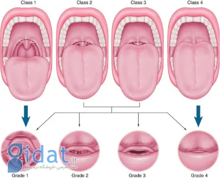 لارینگواسپاسم, اسپاسم حنجره