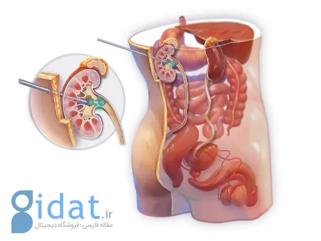 نفرولیتوتومی از راه پوست: راهی سریع برای خلاص شدن از سنگ‌های بزرگ کلیه