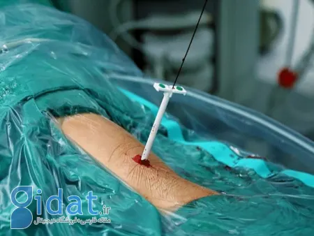 نفرولیتوتومی از راه پوست, عمل PCNL