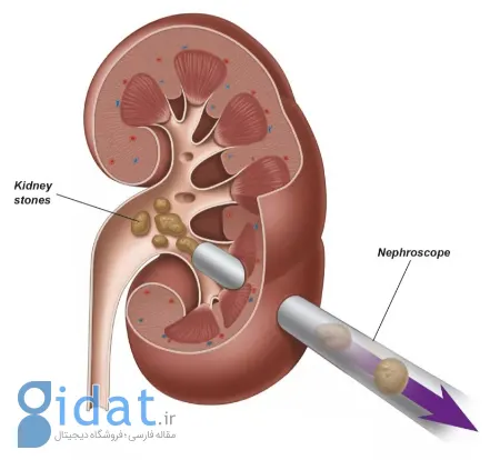 نفرولیتوتومی از راه پوست, عمل PCNL