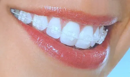 ارتودنسی همرنگ دندان؛ درمان ارتودنسی بدون جلب توجه