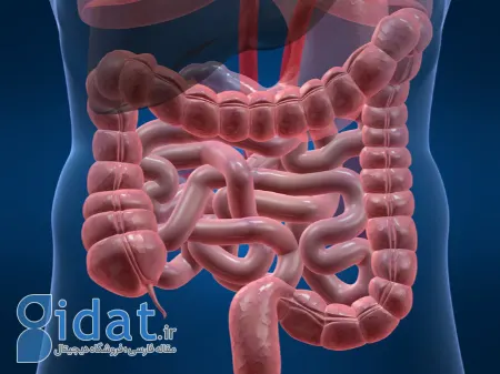 مگاکولون سمی, کولیت اولسراتیو