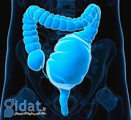 مگاکولون سمی, کولیت اولسراتیو