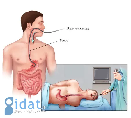 ازوفاژیت, ازوفاژیت التهاب مری