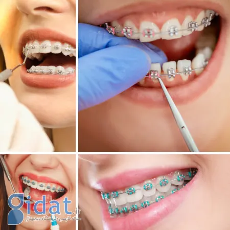 کدام روش ارتودنسی برای شما مناسب است؟ مروری بر انواع روش های ارتودنسی