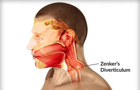 دیورتیکولوم زنکر, اختلال بلع در سالمندان