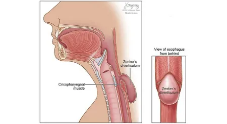 دیورتیکولوم زنکر, اختلال بلع در سالمندان