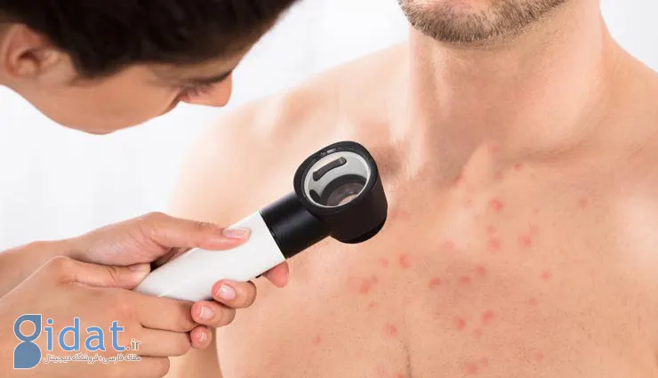 علل جوش سینه و 9 روش برای درمان جوش سینه