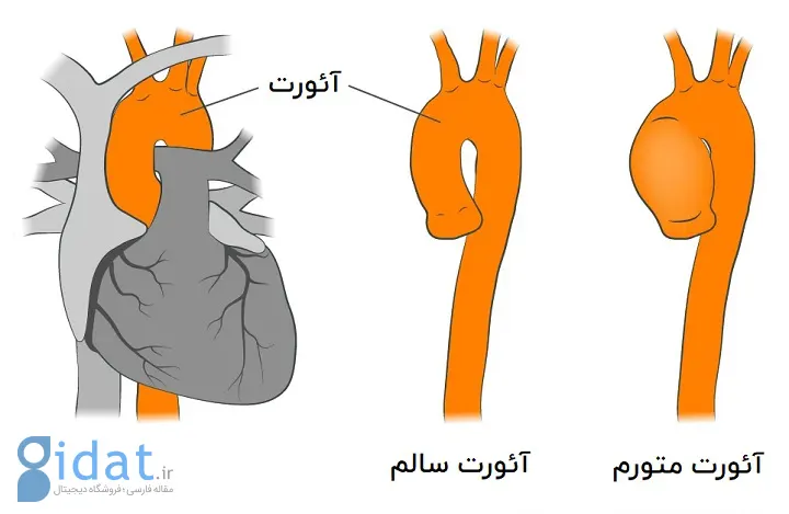 علائم سندرم مارفان - آنوریسم آئورت 