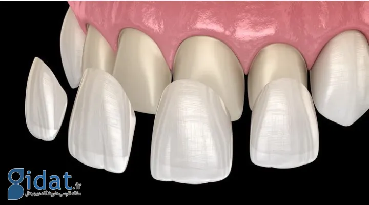 مدلی از قرارگرفتن لمینت دندان روی دندان‌ها