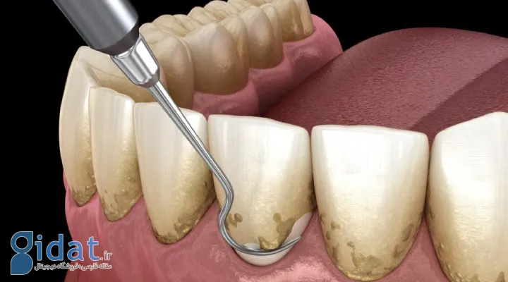 درمان پریودنتیت