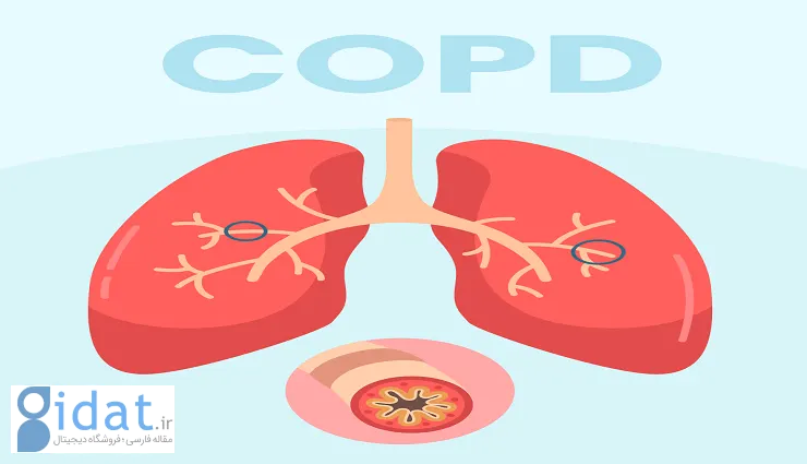 COPD چیست؛ علت، علائم، روش تشخيص و درمان