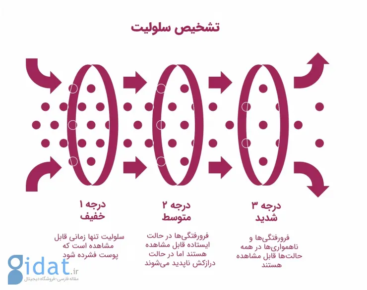 اینفوگرافیک درجه‌بندی شدت سلولیت