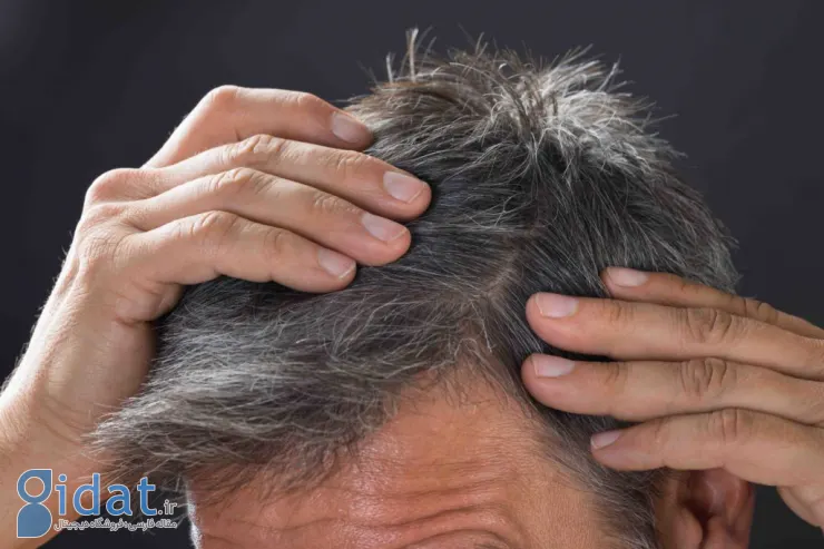 ریزش مو بر اثر استرس: دلایل، تشدید کنندهها، درمانها