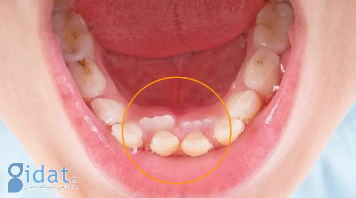 دندان اضافی از علائم سندرم گاردنر