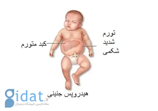 هیدروپس در جنین چیست؟