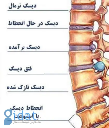 آیا همه دیسکهای بیرون زده ناحیه کمر و گردن دیگر نیاز به جراحی دارند؟