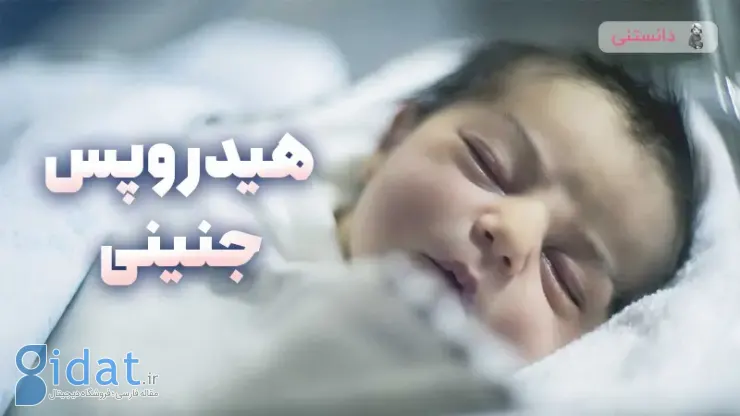 هیدروپس جنینی چیست؟ تشخیص و درمان در بارداری
