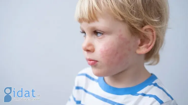 علل حساسیت پوستی فصلی در کودکان