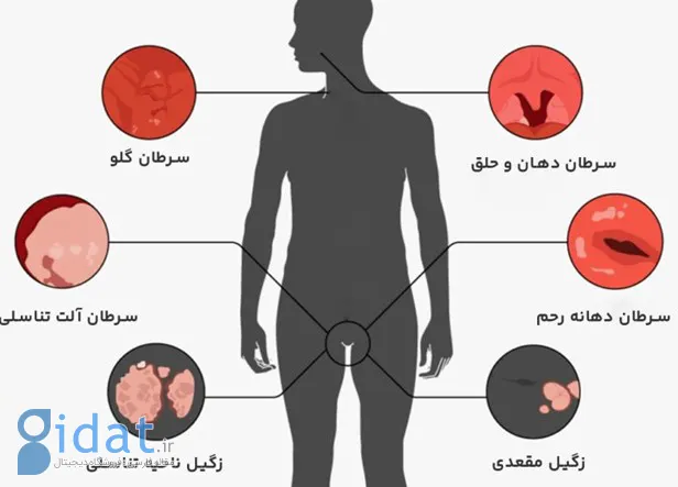 ویروس HPV یا زگیل تناسلی