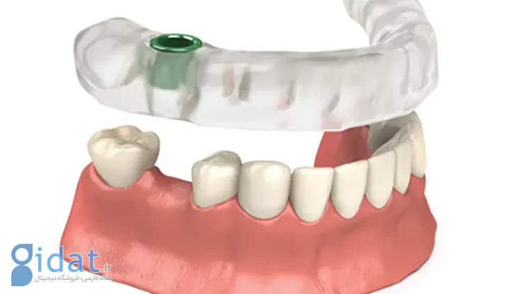 ایمپلنت دندان به روش دیجیتال