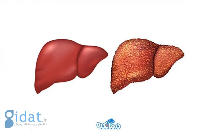 عوارض کبد چرب چیست؟ 3 روش درمان آن