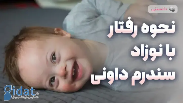 نحوه درمان نوزاد مبتلا به سندرم داون