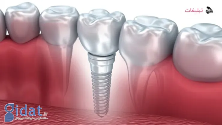 عوامل موثر بر قیمت ایمپلنت دندان