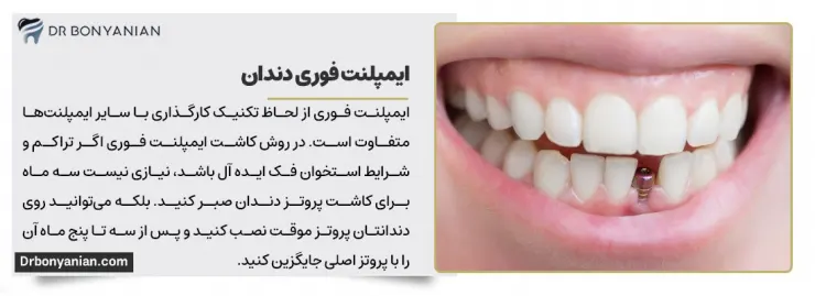 برای انجام ایمپلنت فوری دندان به کجا مراجعه کنیم؟