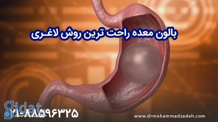 بالون معده ساده ترین راه برای کاهش وزن است