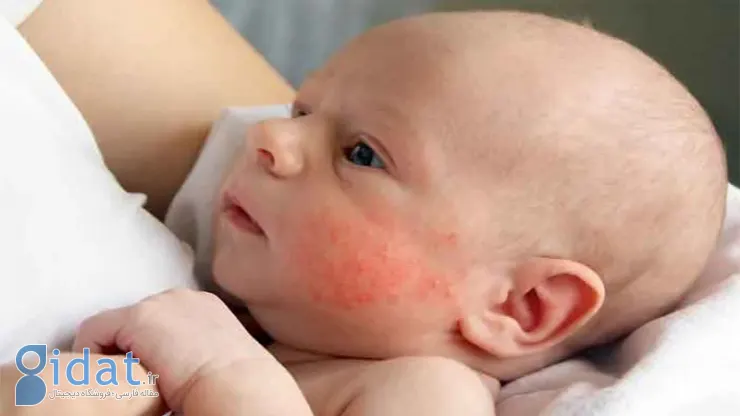 آلرژی نوزاد به شیر خشک