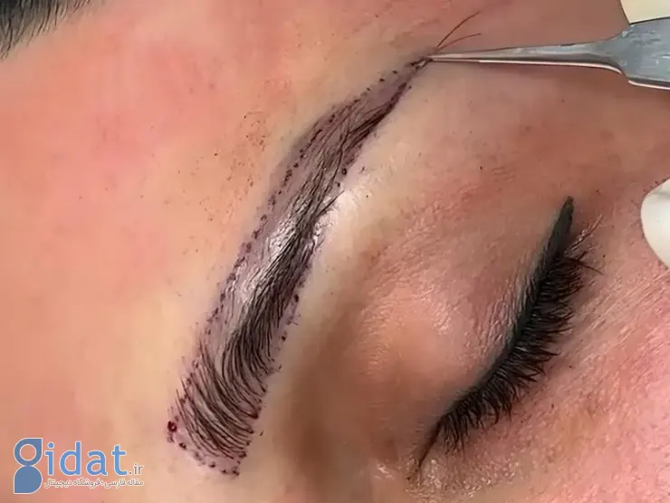 کاشت ابرو در کلینیک مهرزاد
