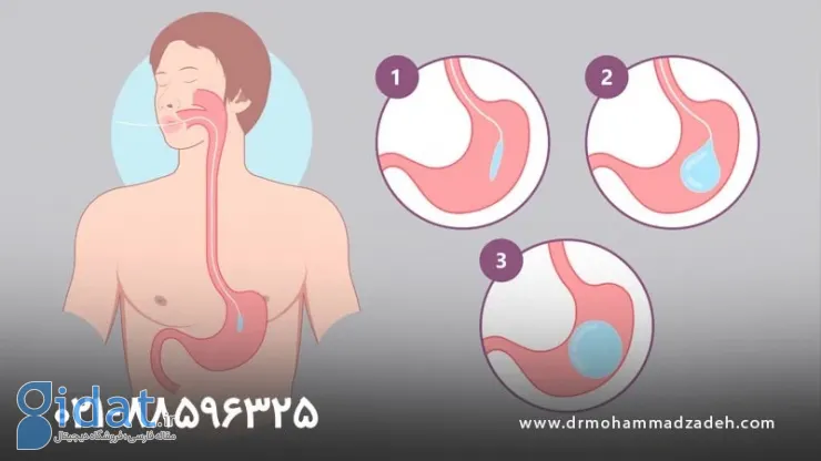 بالون معده راحت ترین روش لاغری