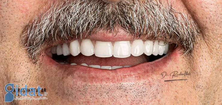 کاشت دندان چیست؟