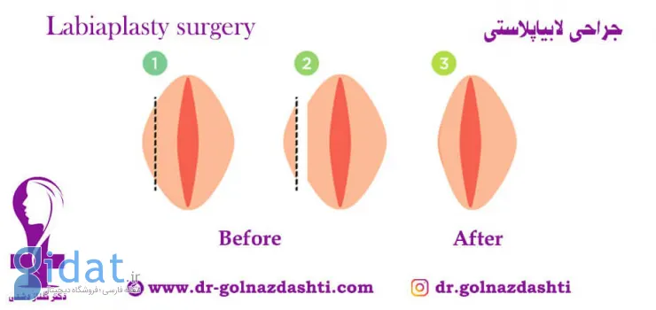 همه چیز راجب جراحی زیبایی واژن (لابیاپلاستی)