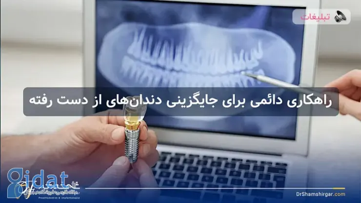 راه حلی دائمی برای جایگزینی دندان های از دست رفته