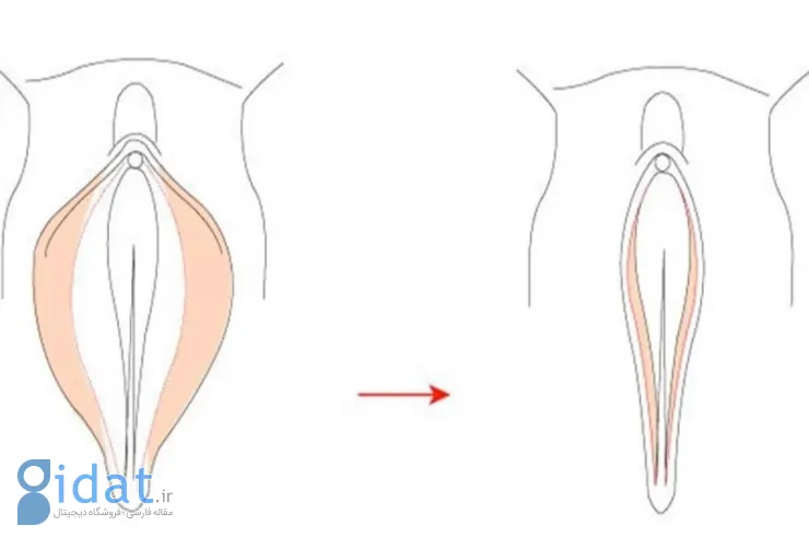 عمل واژینوپلاستی با تنگ کردن واژن