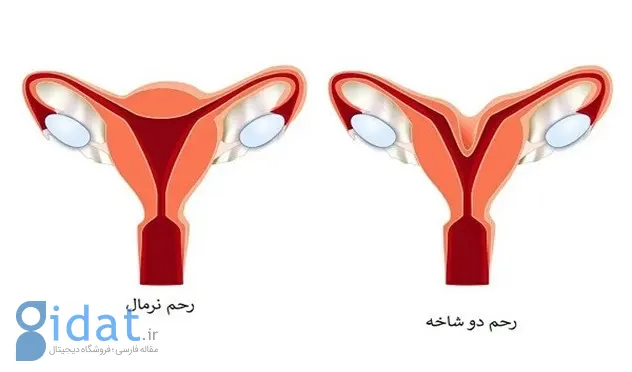 راه تشخیص رحم دو شاخ| نی نی سایت