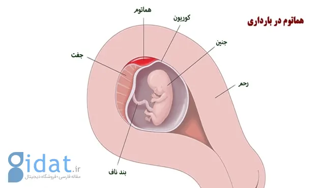 جلوگیری از هماتوم بارداری| نی نی سایت