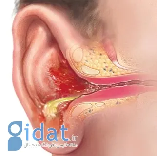 درمان عفونت گوش 